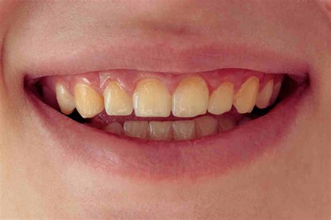 Why Are My Teeth Yellow: Causes and Remedies