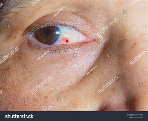 Blood Spot In Eye