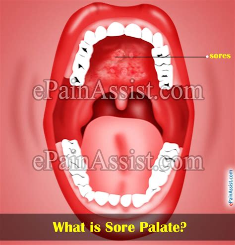 Sore Palate or Sores on Roof of Mouth|Causes & Home Remedies