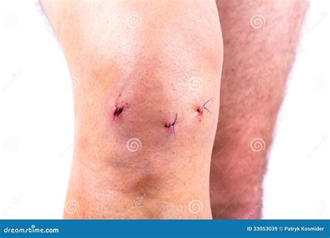 Arthroscopic Knee Surgery Blood Clots at Abby Choi blog