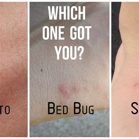 Chigger Bites Vs Bed Bug Bites