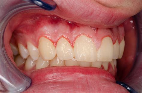 Plaque Teeth Meaning In English at Scotty Young blog