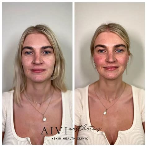 PDO Thread Lift | Non-Surgical Lift in Agoura Hills, CA