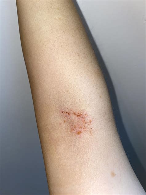 HELP RASH EXPERTS! Anybody know what this rash is on my inner elbow? Have had it a few weeks and ...