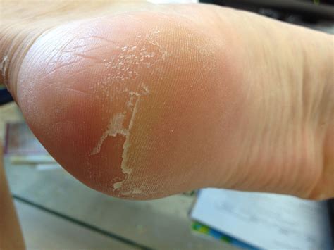Why Is My Cat S Foot Skin Peeling at Luis Silva blog