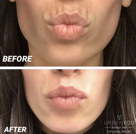 List 100+ Pictures Before And After Lip Flip Photos Superb