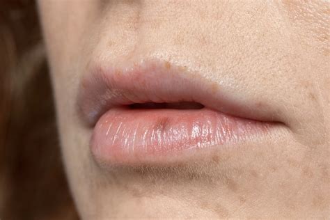 Lip Cancer: Causes, Symptoms & Prevention
