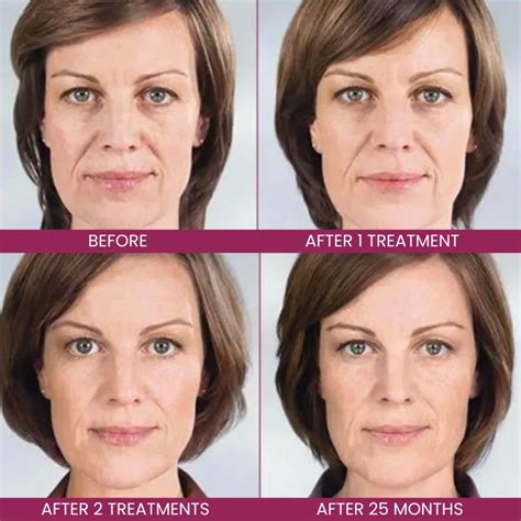 Sculptra in Vancouver WA | Natural Facial Volume & Skin Lift