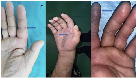 High-Pressure Injection Injury of the Hand—A Rare but True Surgical ...