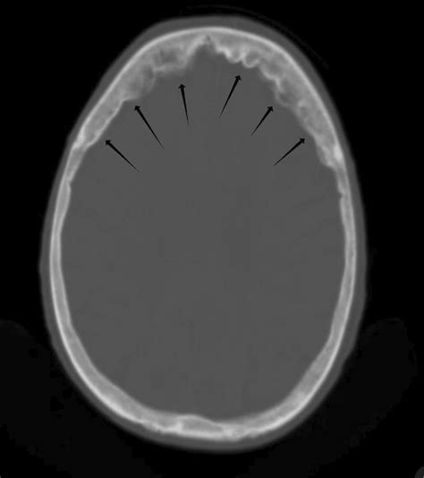 Hyperostosis frontalis interna presenting as a forehead scar in a young male - Khizar - 2023 ...
