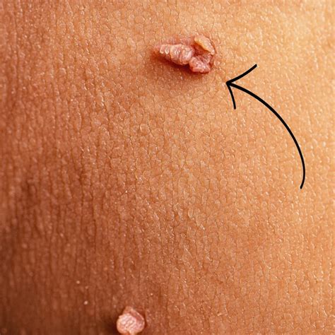Skin Tags vs Cysts vs Warts: Identification Guide