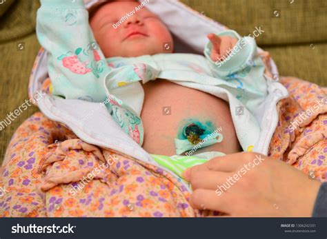 Newborn Baby Umbilical Cord Infection Treatment at Bethany Lindrum blog