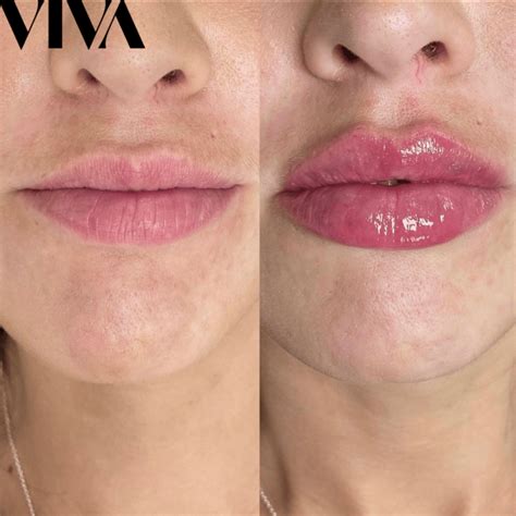 How long does swelling last after lip filler? - VIVA Skin Clinics