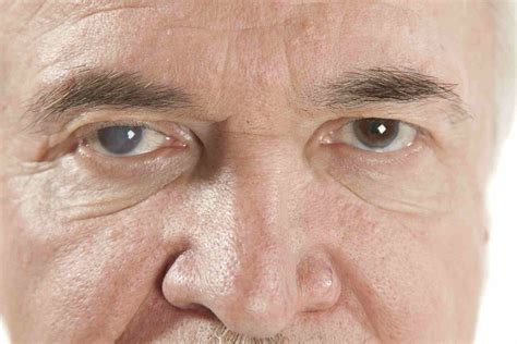 Concussion Cataracts: Meaning, Signs, Diagnosis And Treatment