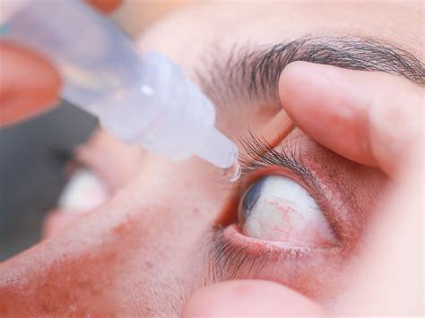 Eyes Quite Sore at Charles Cameron blog