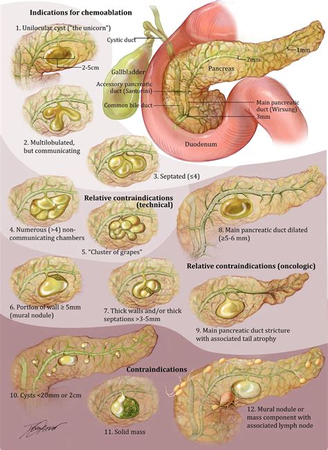 Top tips for EUS-guided pancreatic cyst chemoablation (with video ...