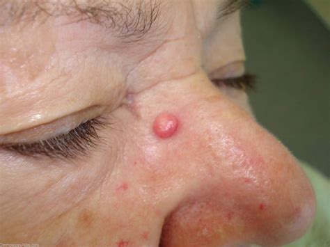 Dermoscopy Atlas | Diagnosis Detail