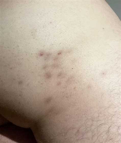 M28 - Butt pimples? How do I treat this? : r/medical