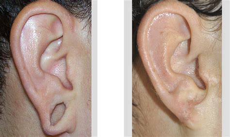 Reconstruction of the Gauged Earlobe Dr Barry Eppley Indianapolis right ear - Explore Plastic ...