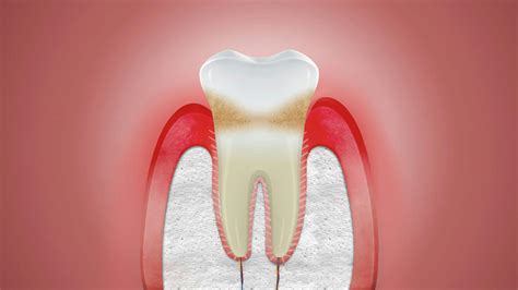 Can receding gums grow back? | Corsodyl