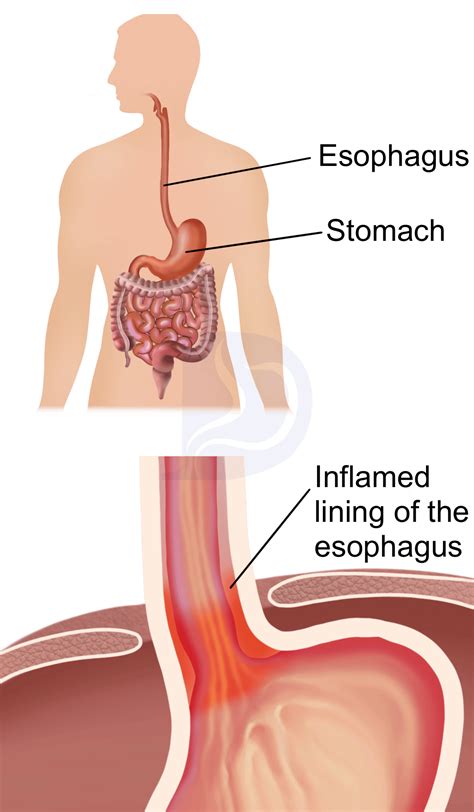 How Do You Fix Esophagus Problems at Carolann Ness blog