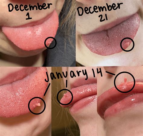 Extremely swollen tastebud for 1+ months - Should I be concerned/see a doctor? : r/medical_advice - white inflamed taste bud