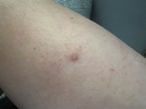 Painless hard lump on my arm. Been there for a couple years. Something to worry about? : r ...