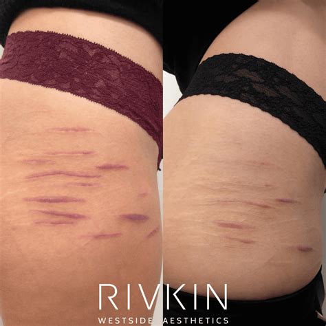 Scars Without Injury at Evan North blog