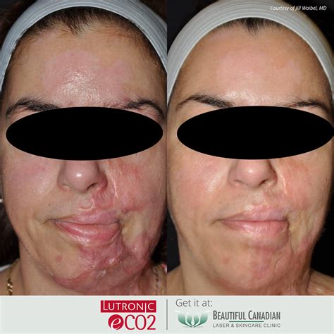 Vancouver Fractional CO2 Laser | Skin Resurfacing Surrey, Delta, Langley
