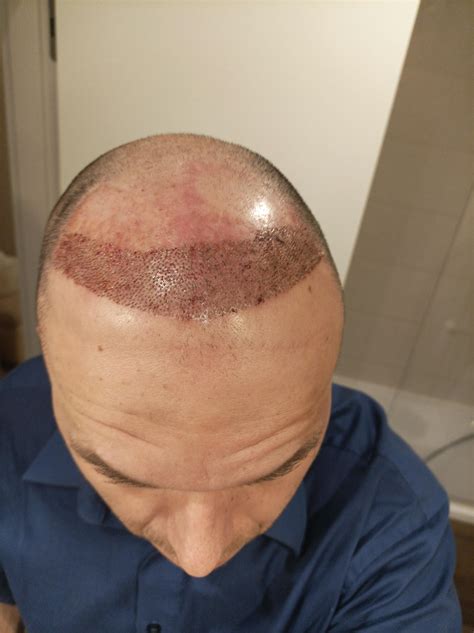 Day 2 /3 of 3000 graft session : r/tressless