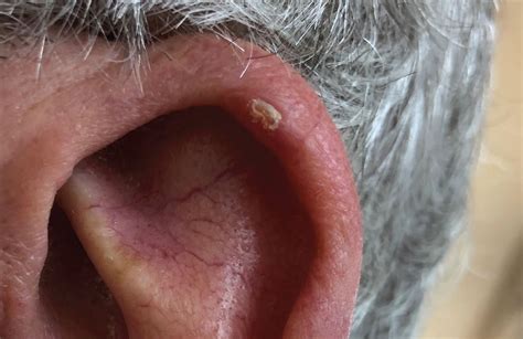 Chondrodermatitis nodularis helicis | Cleveland Clinic Journal of Medicine