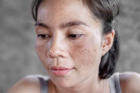 How to Remove Freckles in Singapore? | Eeva Medical Clinic