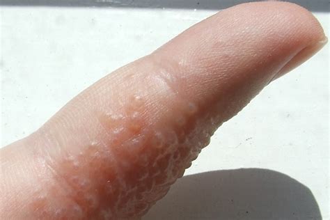 Yeast Infection Bumps On Fingers