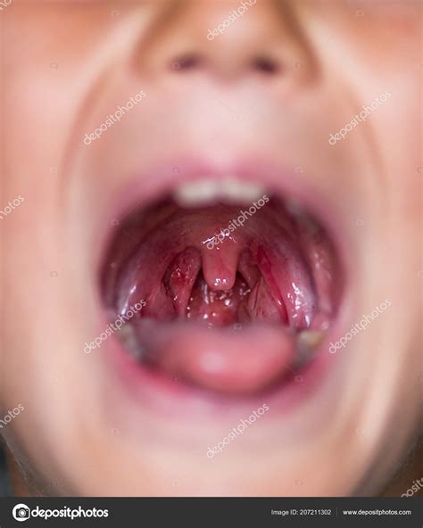 Herpes Throat Infection