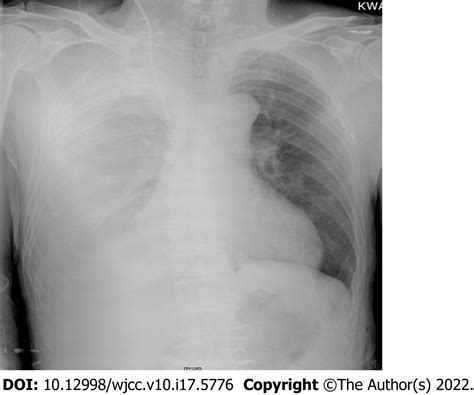 Massive hemothorax following internal jugular vein catheterization ...