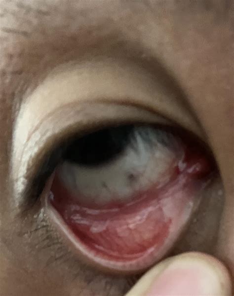 What Are These Black Spots In My Eyes at Piper Walton blog