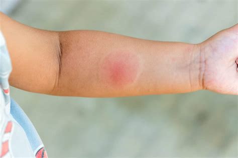 Skeeter Syndrome: Mosquito Bite Symptoms & Treatment | STC