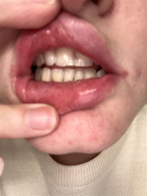 Canker Sores