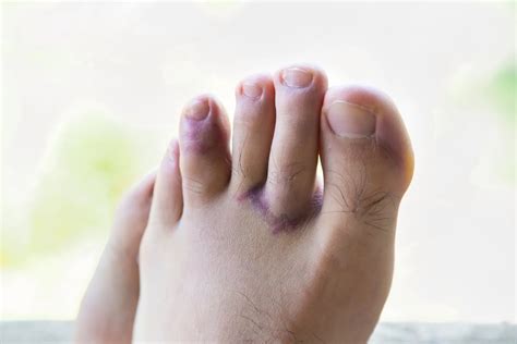 Toe Break Symptoms