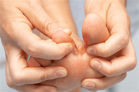 How to get rid of soft corn between toes.