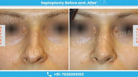 Best Septoplasty Surgeon & Septorhinoplasty Cost in Mumbai, India | Rhinoplasty Surgeon India