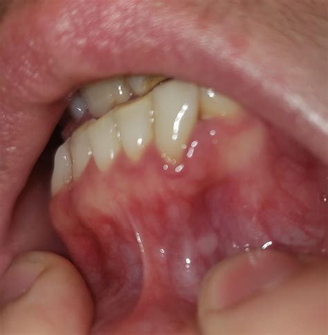 White Spots On Gums Spreading at Phoebe Doane blog