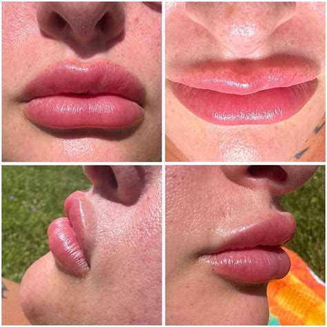 Got my lip filler dissolved today : r/cosmeticsurgery