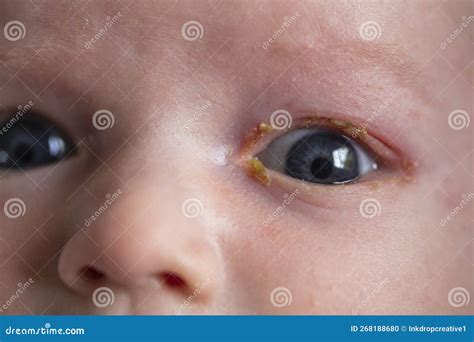 A Close Up of a Young Baby with a Common Sore Sticky Eye Infection ...