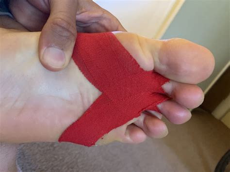 Taping Plantar Fasciitis At Night at Cynthia Shackelford blog