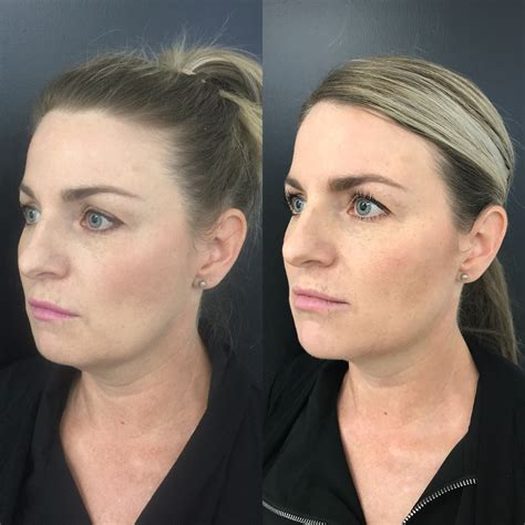 Non Surgical Face Lift For Jowls at Renee McConnell blog