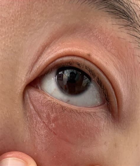 Eczema On Eyelids And Eyebrows at Norris Carrico blog