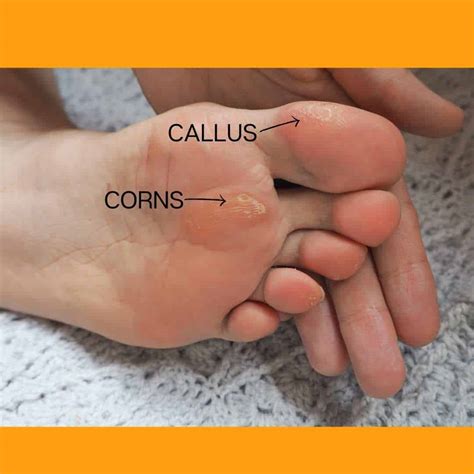 How to Prevent and Treat Corns and Calluses | New Step Podiatry Belconnen