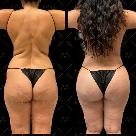 Fat Transfer To Butt