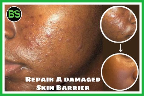 Damaged skin repair – Artofit